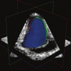 Real-time segmentation of 4D ultrasound by Active Geometric Functions