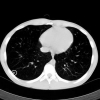 Reducing false positive responses in lung nodule detector system by asymmetric adaboost